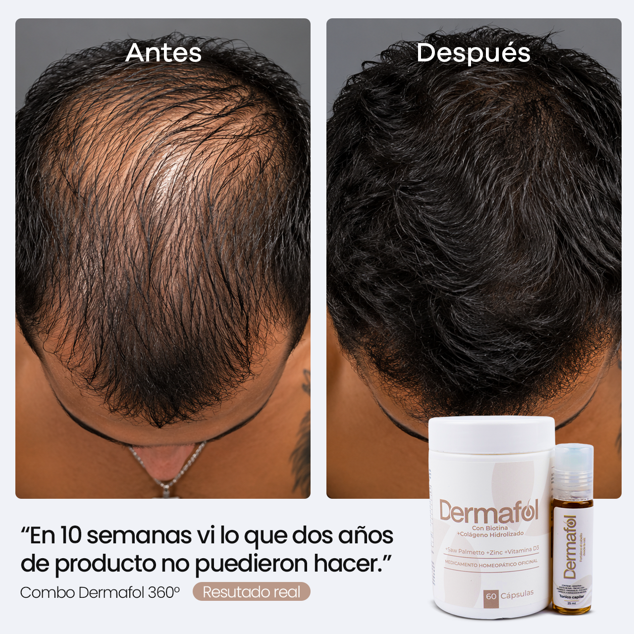 Combo Dermafol 360° | Trata la causa hormonal